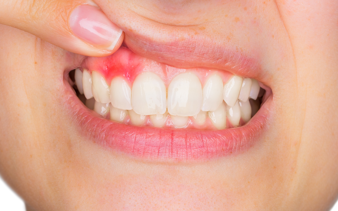 7 Early Warning Signs Showing You May Have Gingivitis!
